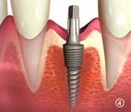 illu-campions-implantate4